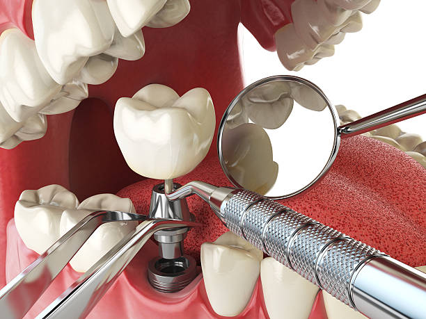 Best Emergency Dental Care for Broken or Chipped Teeth in River Hills, WI